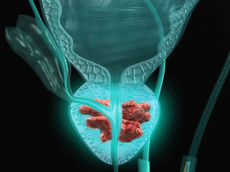 lazer prostat ameliyati 2