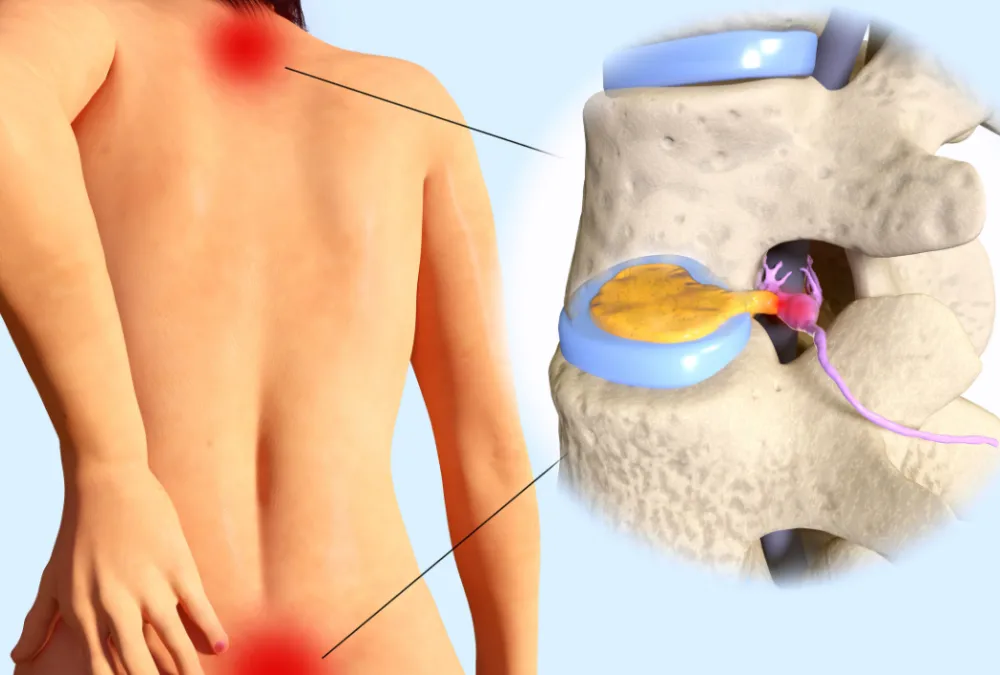 ameliyatsiz bel fitigi