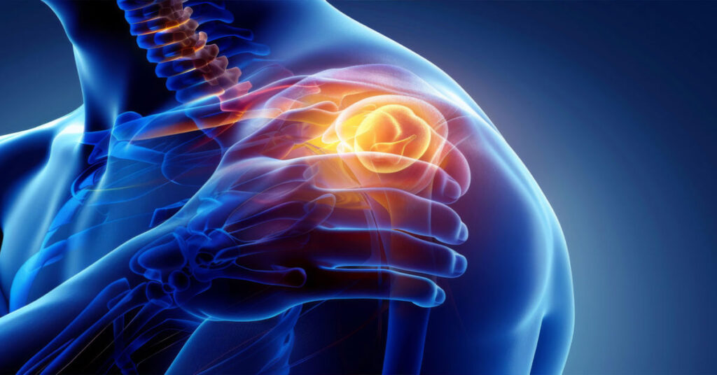 omuz kireclenmesi nedir 2