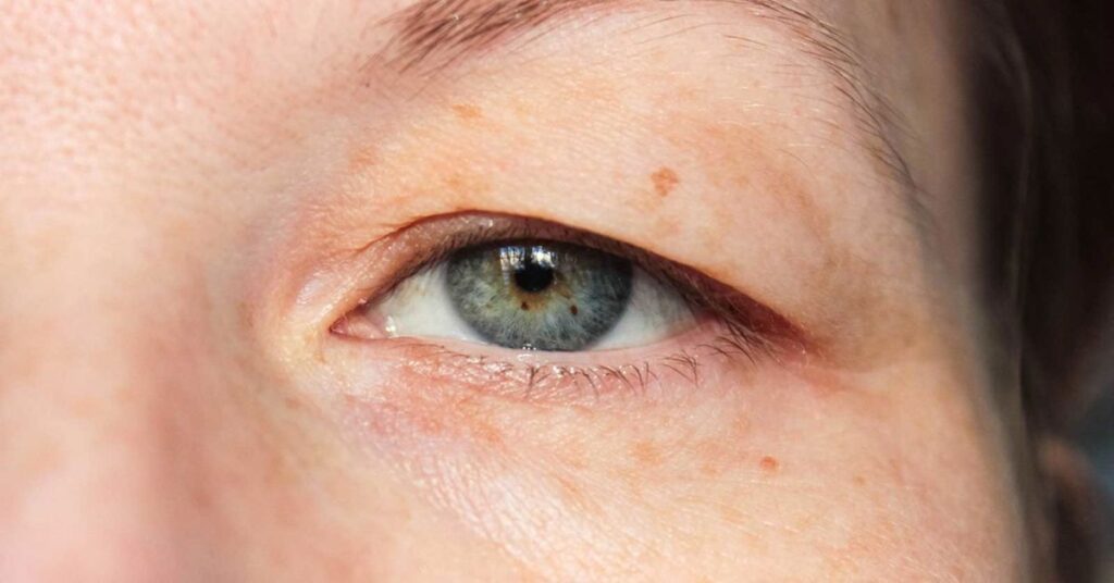 goz kapagi dusuklugu ameliyati 2